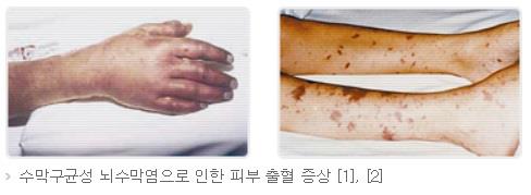 뇌수막염