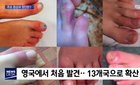 코로나19 합병증? '어린이 괴질' 의심 사례 2건 첫 발생