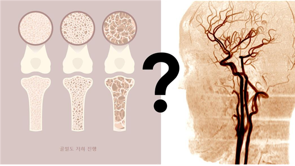 뼈 밀도가 뇌혈관질환과 관련 있다?
