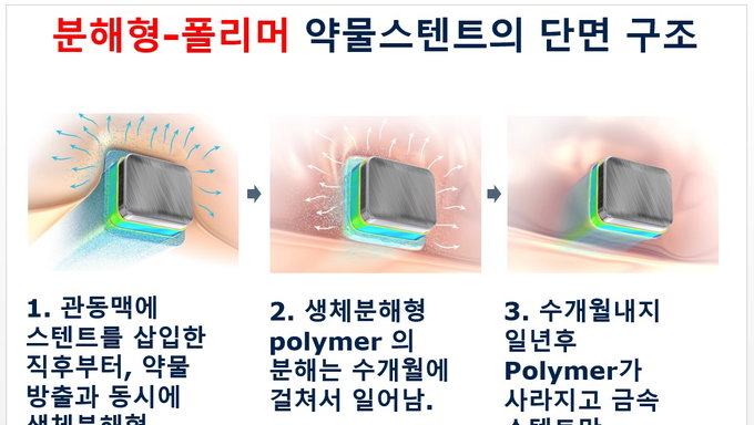 심근경색증 환자에 적합한 약물 스텐트는?