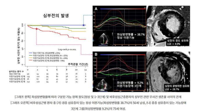 서울대병원 연구팀, 비후성심근환자의 심부전 위험 간편한 예측방법 찾아