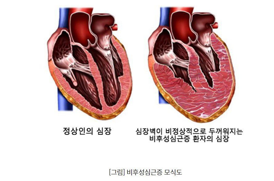 [그림] 비후성심근증 모식도