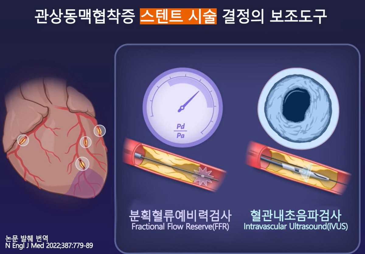[사진] 관상동맥협착증 스텐트 시술 결정의 보조도구(출처: NEJM)
