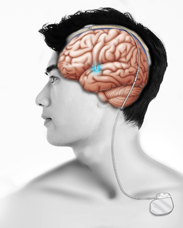 [그림2] 뇌심부자극술로 자극용 전극 삽입한 모식도 =서울대병원
