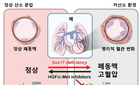 폐동맥 고혈압 위험 높이는 유전자 경로 찾았다