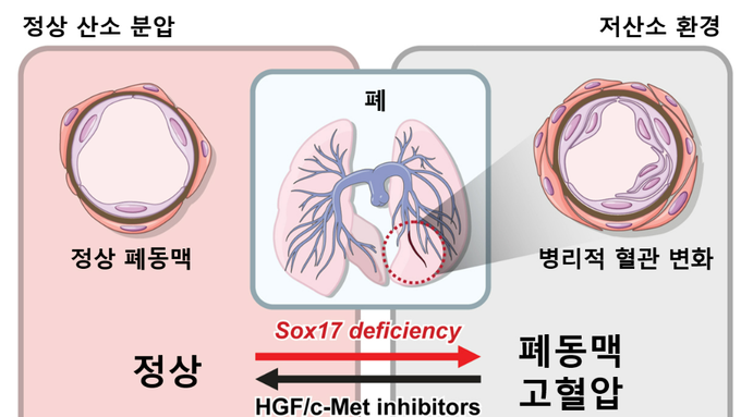 폐동맥 고혈압 위험 높이는 유전자 경로 찾았다