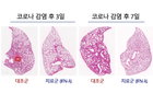 서울대병원 연구팀, 코로나·폐렴 완화하는 흡입형 치료제 개발 위한 연구에 박차