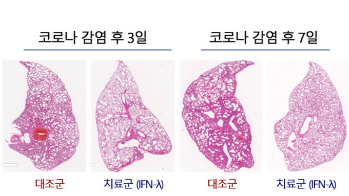 서울대병원 연구팀, 코로나·폐렴 완화하는 흡입형 치료제 개발 위한 연구에 박차