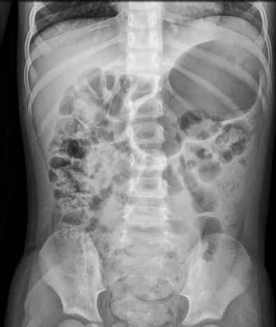소아복부 x-ray 이미지.