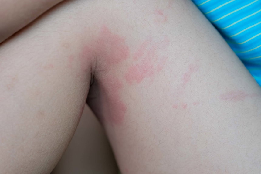 홍역은 전염성이 매우 높은 바이러스성 질환으로 백신 접종이 최선의 예방법이다.