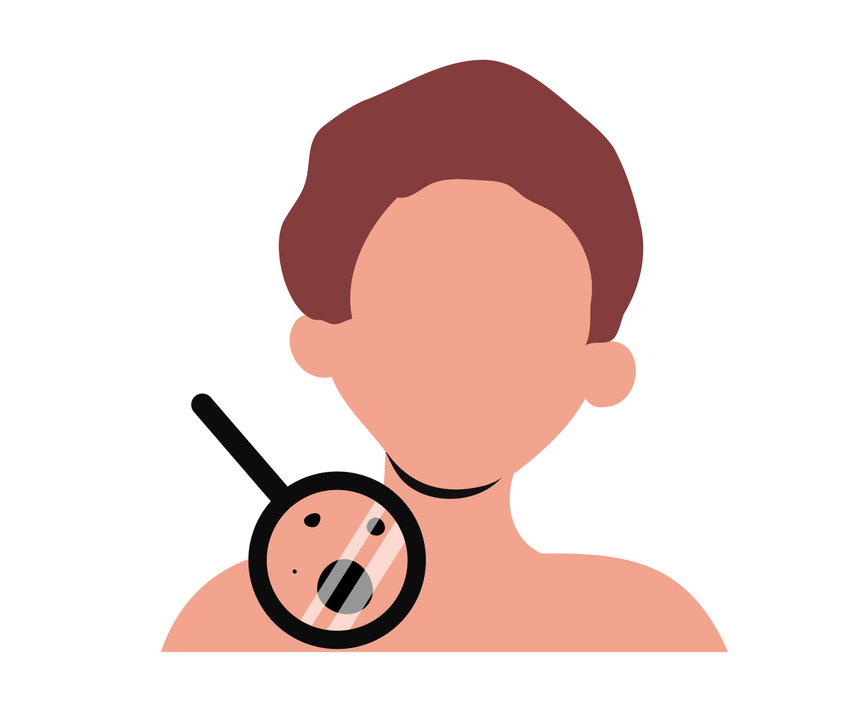 피부암은 기저세포암, 편평세포암, 악성흑색종이 대표적으로, 자외선 노출이 가장 큰 원인이다.