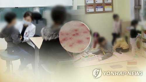 광주 수두 환자 전년 대비 1.5배 폭증... 12주 차 발생률 4.5배 급증 ... 아동&middot;청소년 집단 감염 주의보
