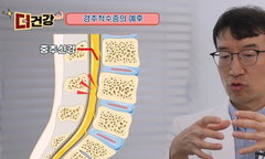 스마트폰이 부른 '사지마비' 경추척수증 경고