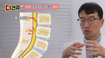 스마트폰이 부른 '사지마비' 경추척수증 경고