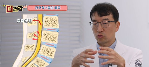 스마트폰이 부른 '사지마비' 경추척수증 경고