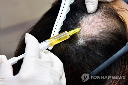 탈모 건보 확대, '생존의 문제'인가 '재정 고갈의 늪'인가…공론화 임박