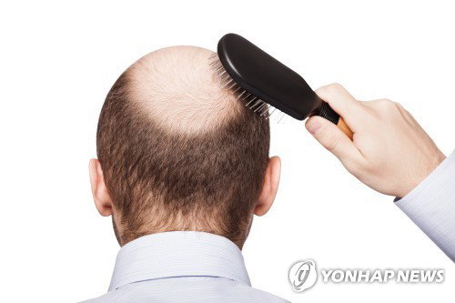 탈모약 건보화, 재정 1,797억 추산…7월 토론회 '이정표' 될까