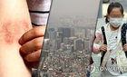알레르기 비염 20년 새 2.5배 폭증…'골든타임' 놓치면 치명