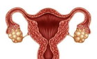 가임기 여성 15% 괴롭힌 PCOS, 14년 만에 'PMOS'로 환자 중심 변화