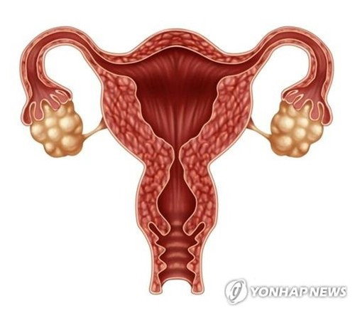 가임기 여성 15% 괴롭힌 PCOS, 14년 만에 'PMOS'로 환자 중심 변화