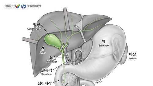 비만, 담낭암 위험 69%↑…여성 비만 77% '치명적 경고'