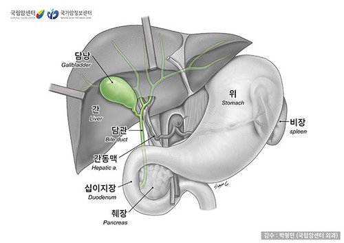 비만, 담낭암 위험 69%↑…여성 비만 77% '치명적 경고'
