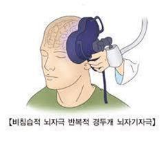 강박장애, 뇌회로 최초 규명…정밀 치료 시대 연다