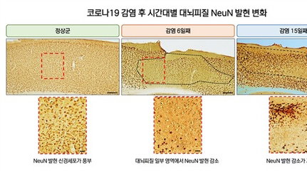 코로나19 후유증 '브레인 포그' 원인 단서 포착, 희망의 서막 열리나?
