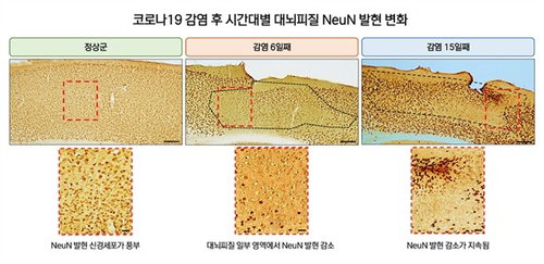 코로나19 후유증 '브레인 포그' 원인 단서 포착, 희망의 서막 열리나?