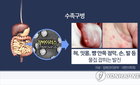 "작년의 2배" 수족구병 7주째 급확산…영유아 있다면 지금 당장 확인하세요