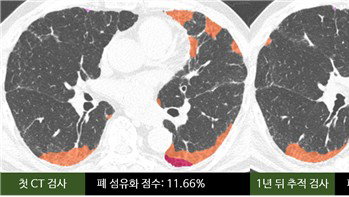 AI, 폐섬유증 4% 변화로 예후 예측…맞춤치료 새 지평