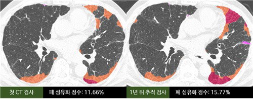 AI, 폐섬유증 4% 변화로 예후 예측…맞춤치료 새 지평